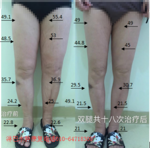 子宫全切术后双腿淋巴水肿怎么办？北京善尔医院康复案例
